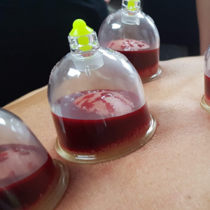 hijama