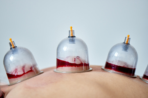 hijama