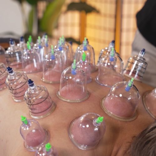 Cupping met plastic cups